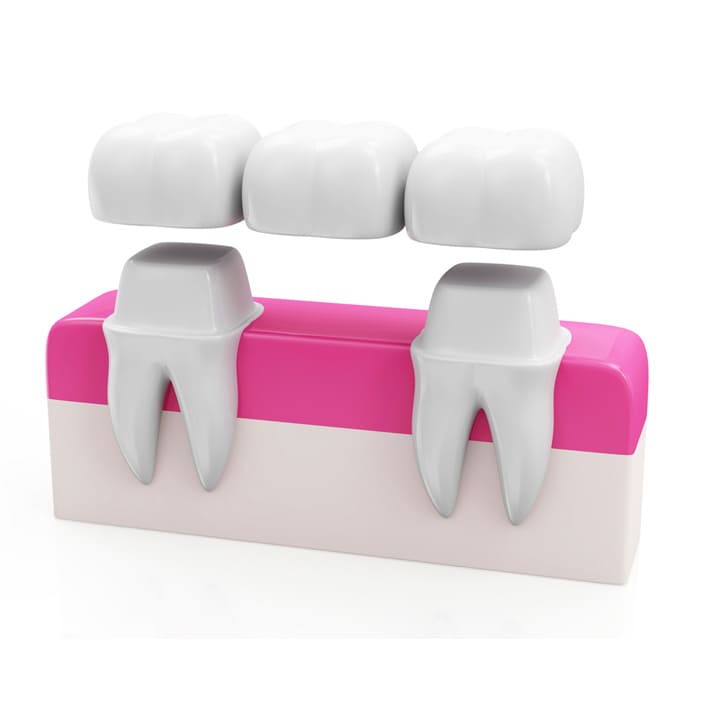 Bridges for Teeth