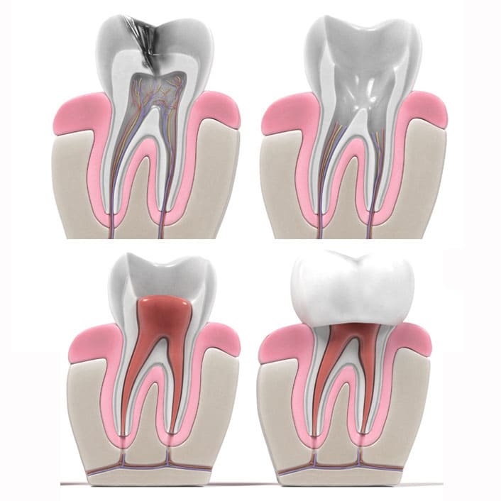 Root Canals